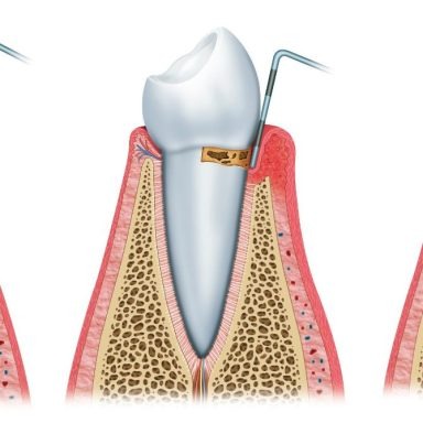 Periodoncia